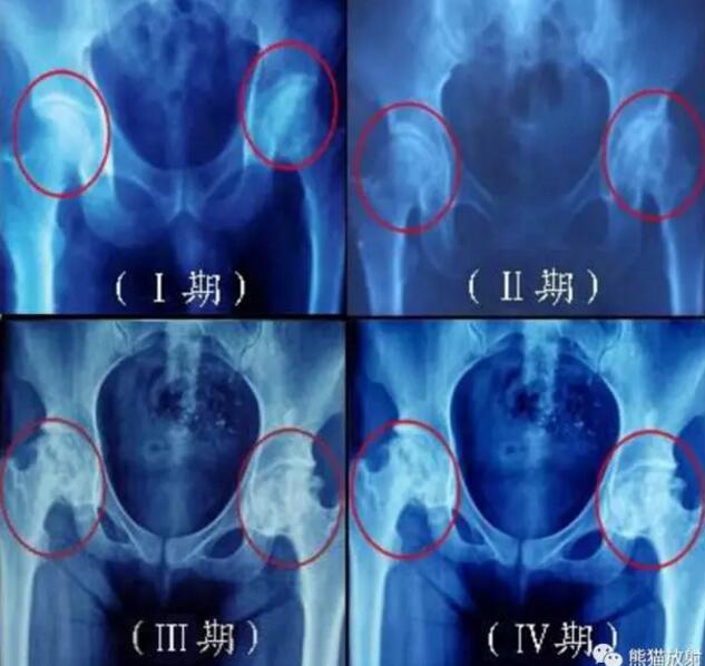 股骨头缺血性坏死的分期及诊断要点