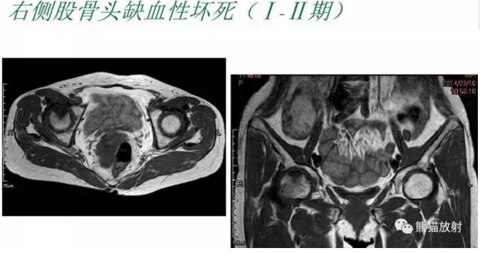 股骨头缺血性坏死的分期及诊断要点