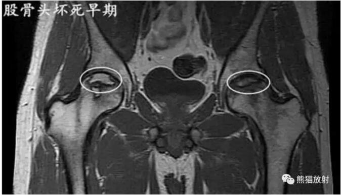 股骨头缺血性坏死的分期及诊断要点