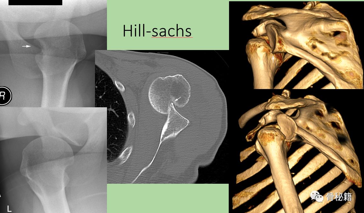 hill-sachs图片