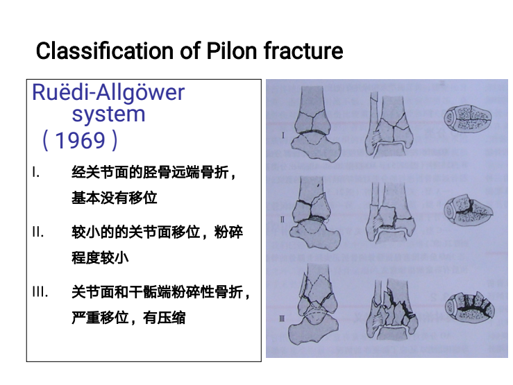 Pilon骨折的手术技术要点