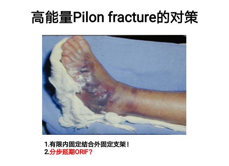 Pilon骨折的手术技术要点