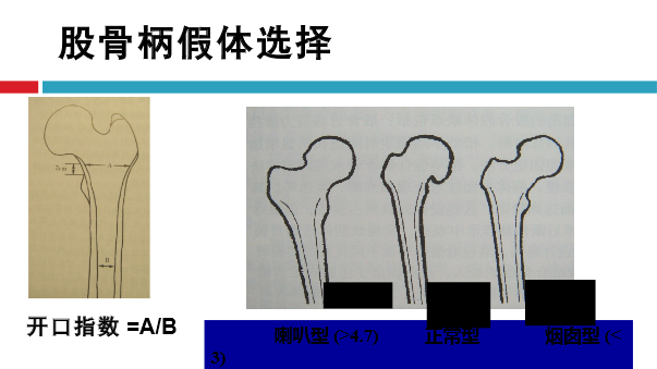 髋关节初次置换的基本原则与技术