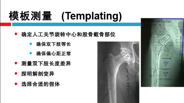 髋关节初次置换的基本原则与技术