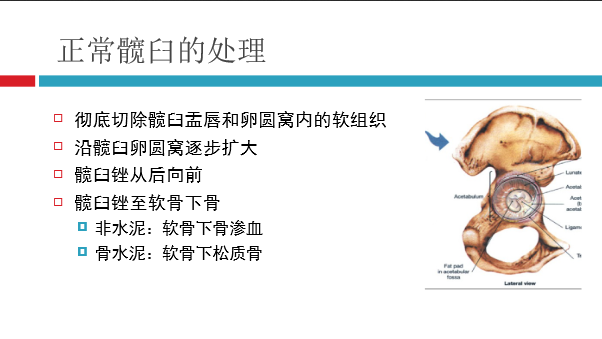 髋关节初次置换的基本原则与技术