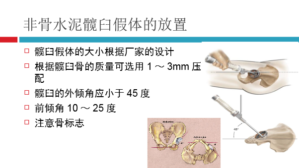 髋关节初次置换的基本原则与技术