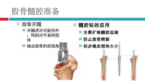 髋关节初次置换的基本原则与技术