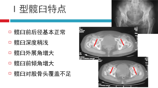 髋关节初次置换的基本原则与技术