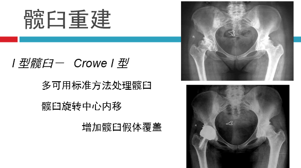 髋关节初次置换的基本原则与技术