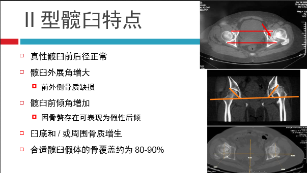 髋关节初次置换的基本原则与技术