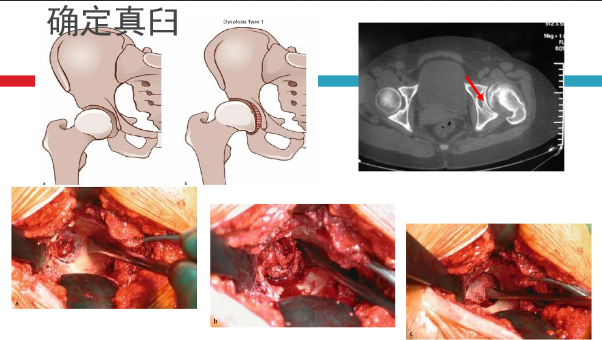 髋关节初次置换的基本原则与技术