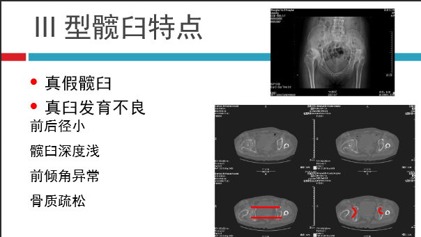 髋关节初次置换的基本原则与技术