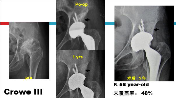 髋关节初次置换的基本原则与技术