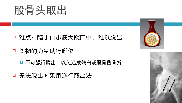 髋关节初次置换的基本原则与技术