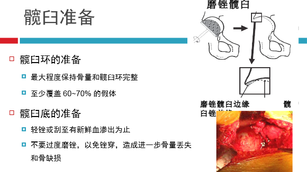 髋关节初次置换的基本原则与技术