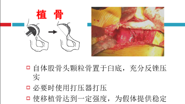 髋关节初次置换的基本原则与技术