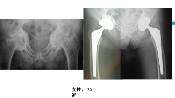 髋关节初次置换的基本原则与技术