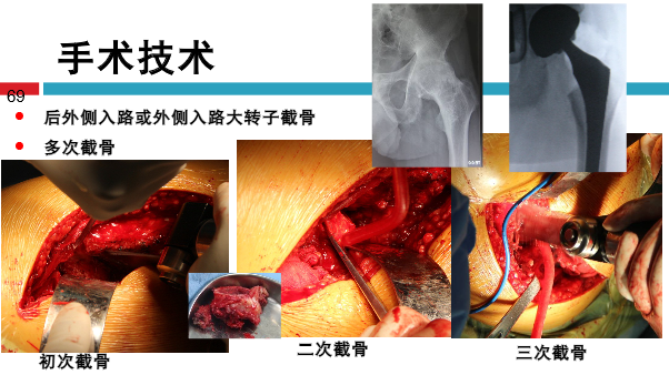 髋关节初次置换的基本原则与技术