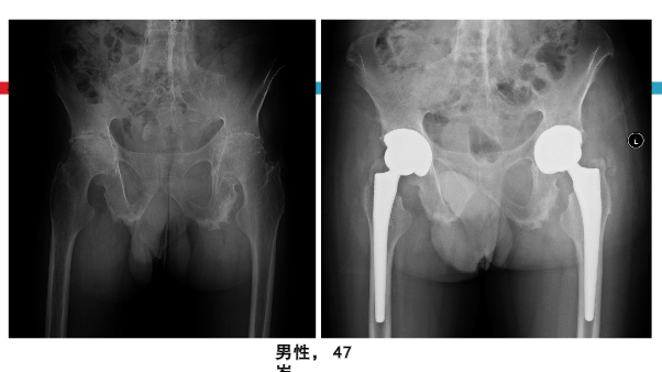 髋关节初次置换的基本原则与技术