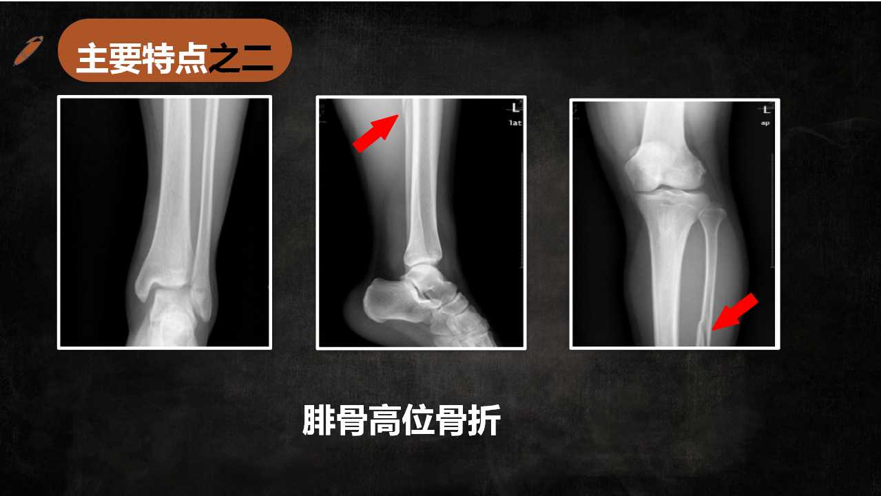 一篇课件读懂特殊类型的踝关节骨折