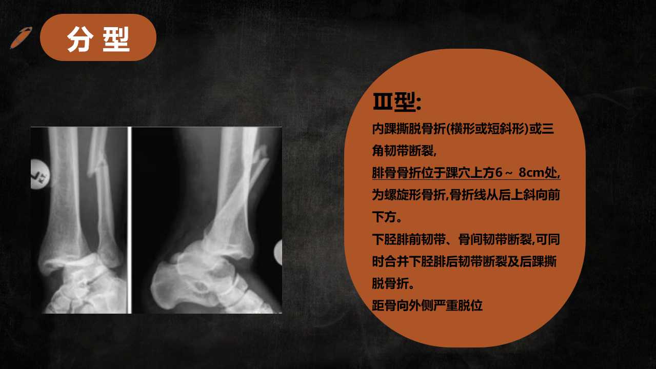 一篇课件读懂特殊类型的踝关节骨折