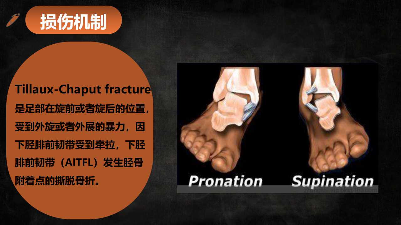 一篇课件读懂特殊类型的踝关节骨折