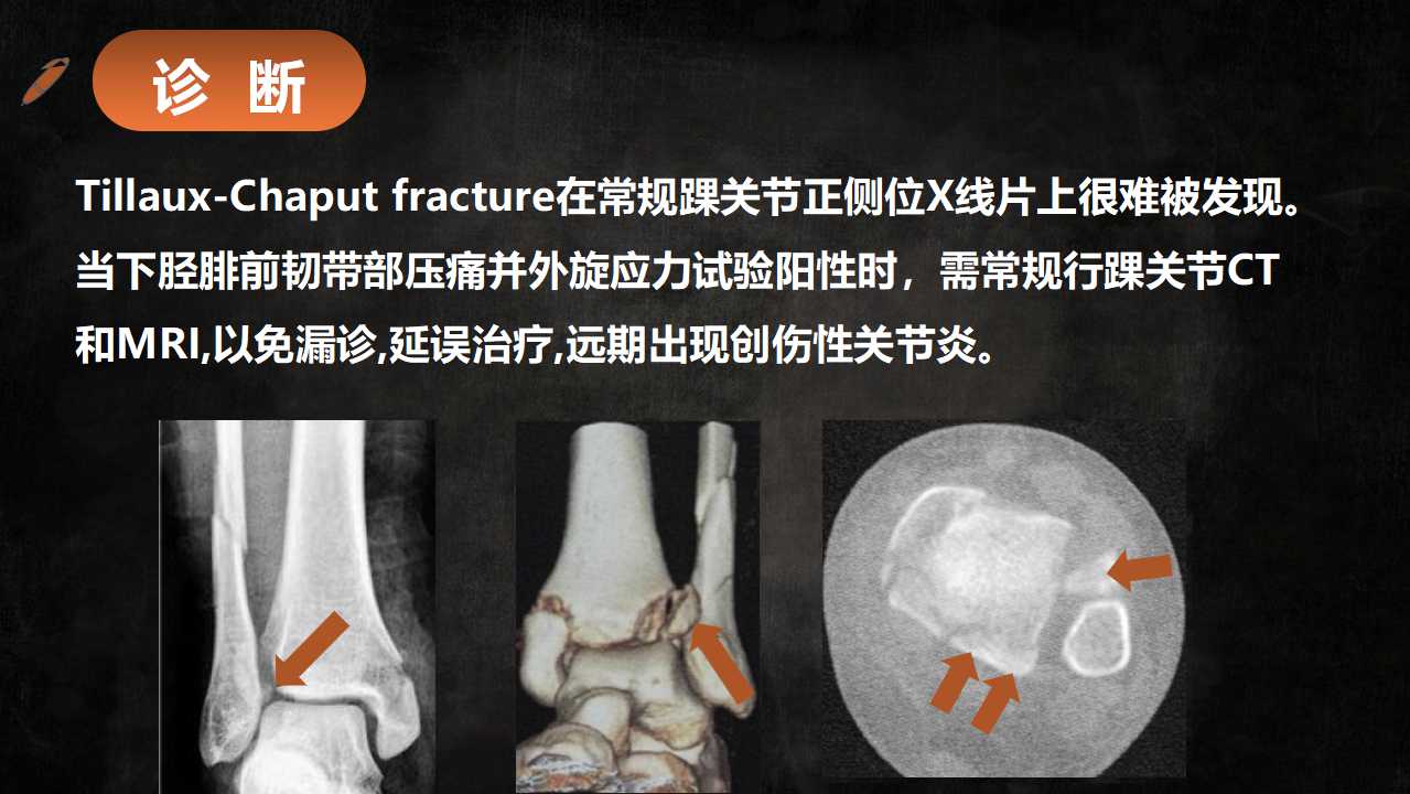 一篇课件读懂特殊类型的踝关节骨折