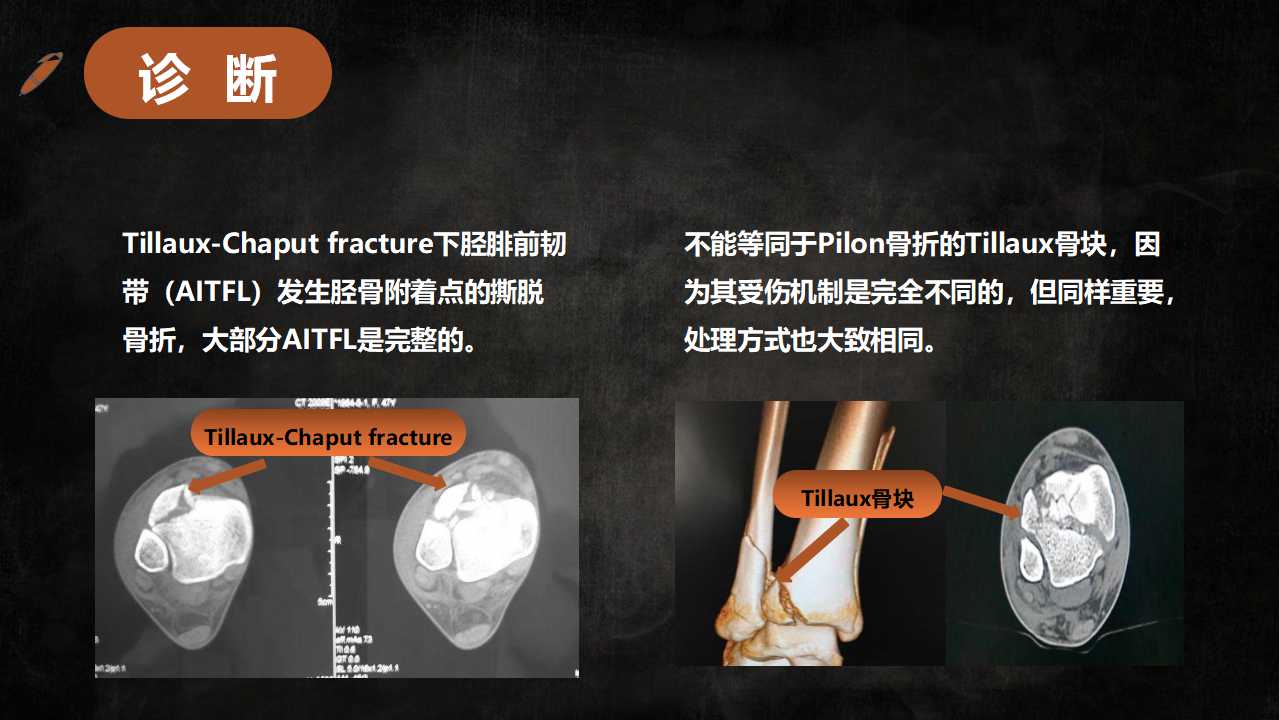 一篇课件读懂特殊类型的踝关节骨折