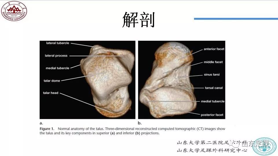 距骨骨折概述