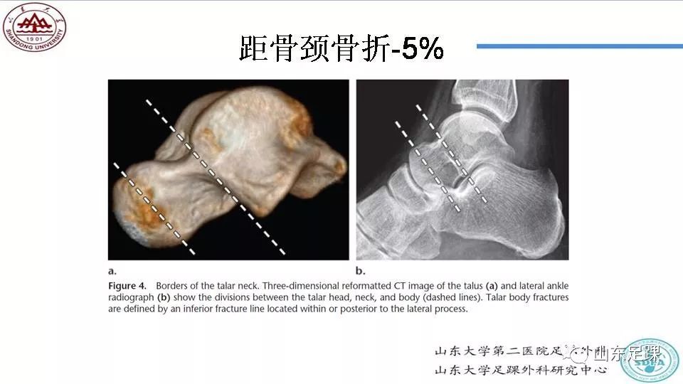 距骨骨折概述