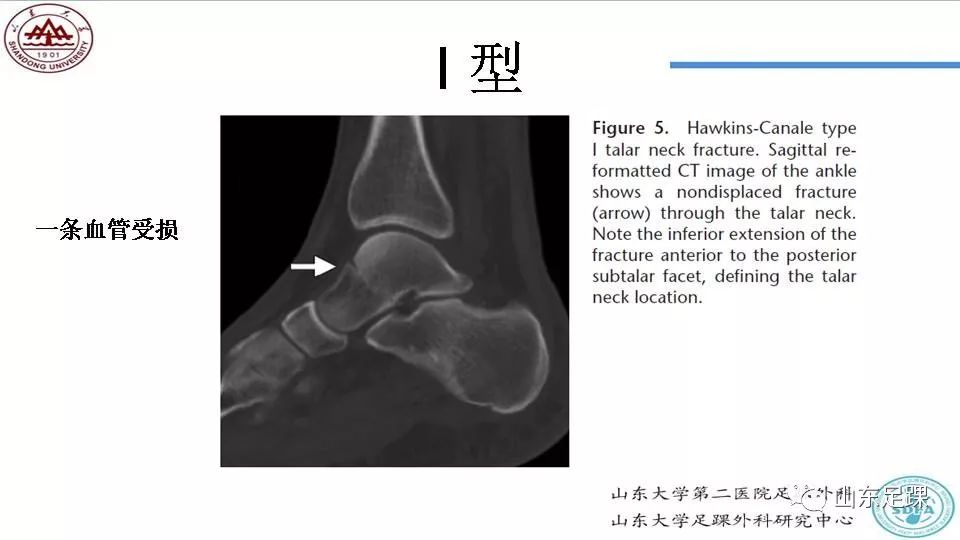 距骨骨折概述