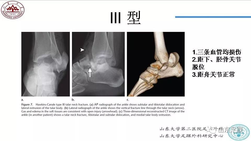 距骨骨折概述