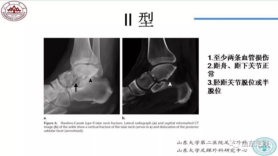 距骨骨折概述