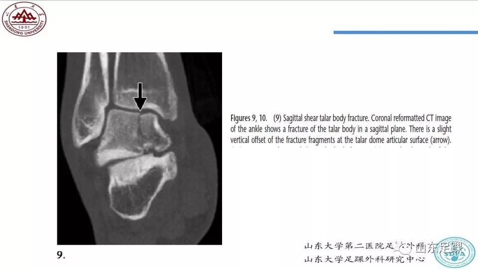 距骨骨折概述