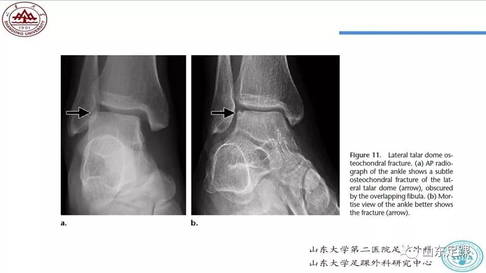 距骨骨折概述