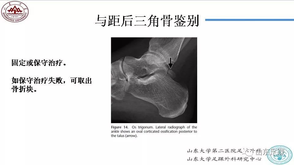 距骨骨折概述