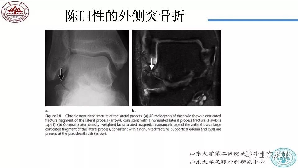 距骨骨折概述