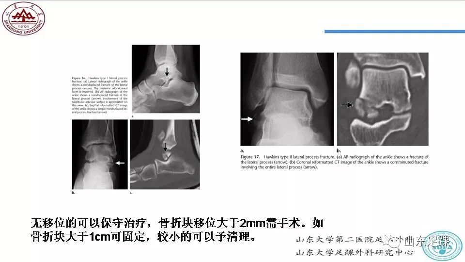 距骨骨折概述