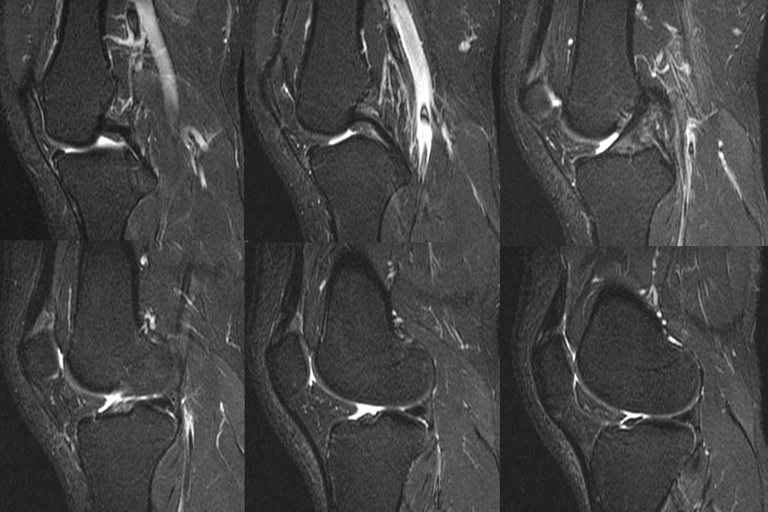 膝关节韧带损伤的MR诊断