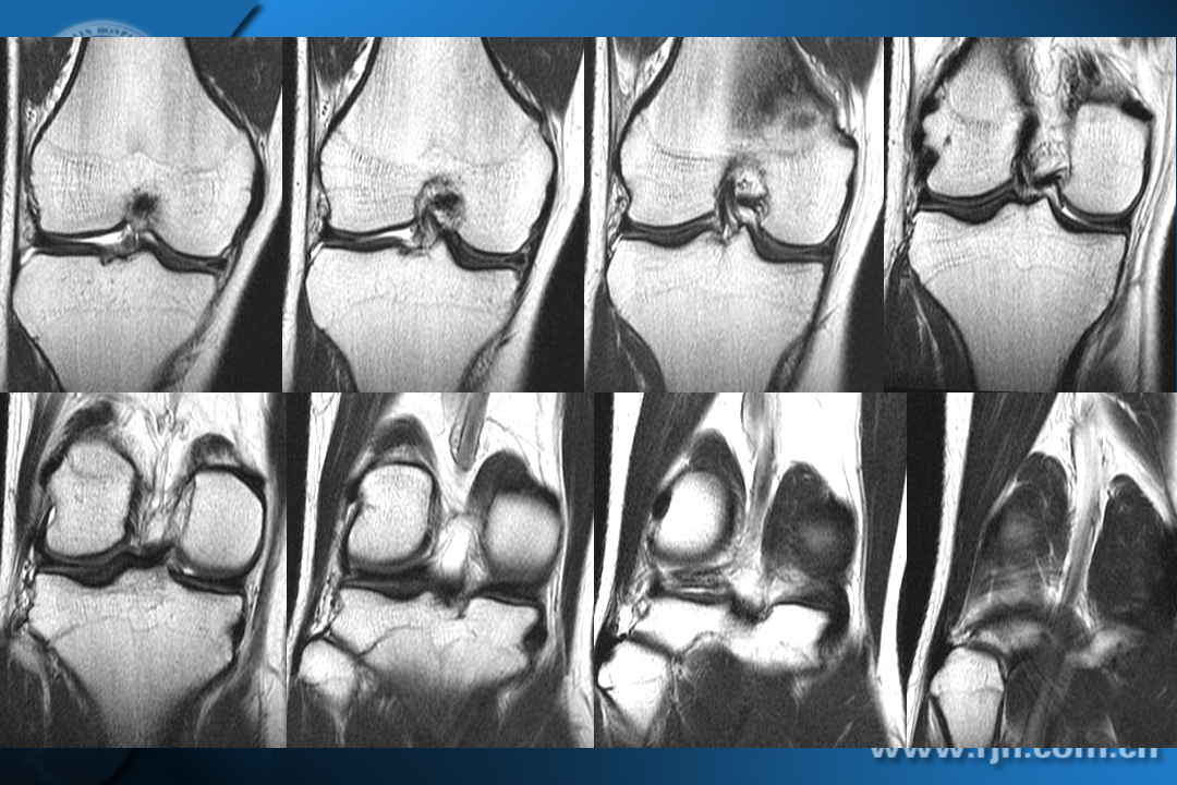 膝关节韧带损伤的MR诊断