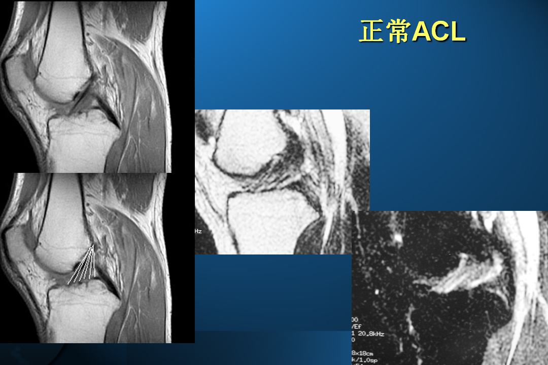 膝关节韧带损伤的MR诊断
