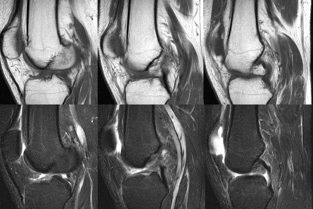 膝关节韧带损伤的MR诊断