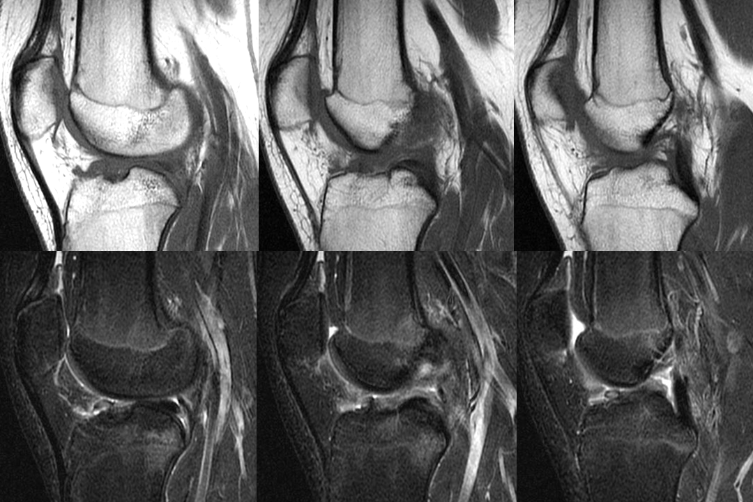 膝关节韧带损伤的MR诊断