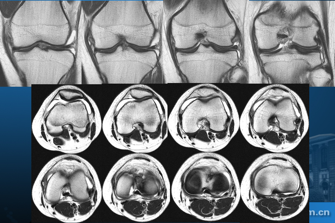膝关节韧带损伤的MR诊断