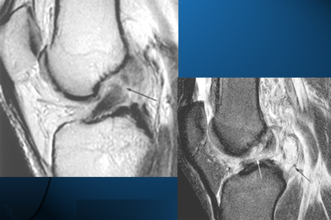膝关节韧带损伤的MR诊断