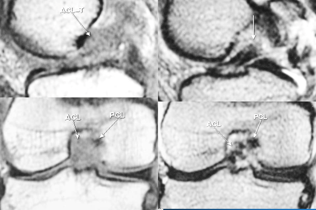 膝关节韧带损伤的MR诊断