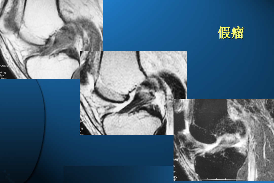 膝关节韧带损伤的MR诊断
