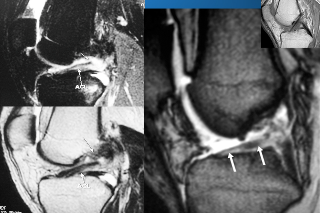 膝关节韧带损伤的MR诊断
