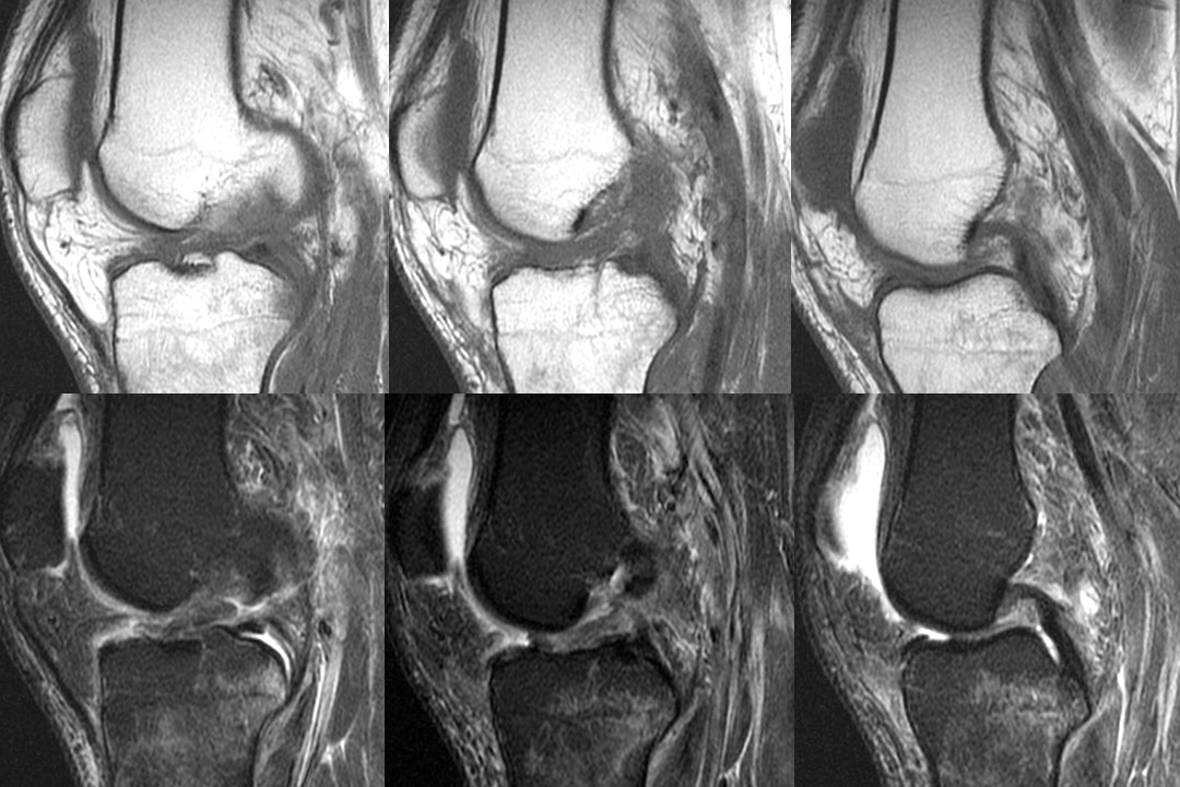 膝关节韧带损伤的MR诊断