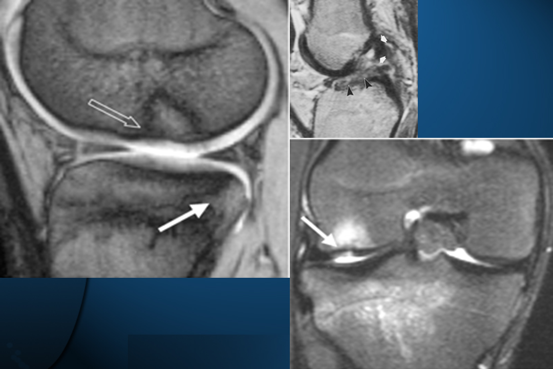 膝关节韧带损伤的MR诊断
